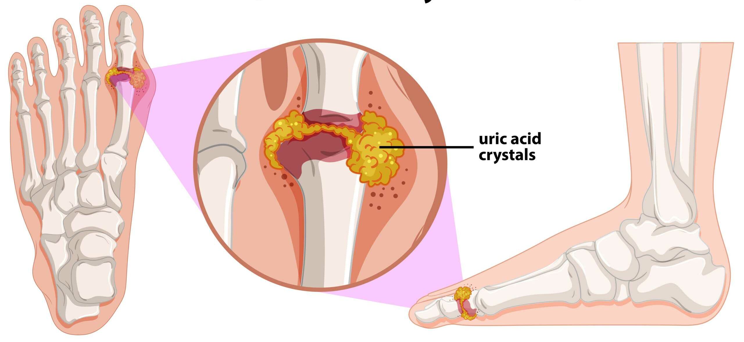 How to Cure High Uric Acid Naturally