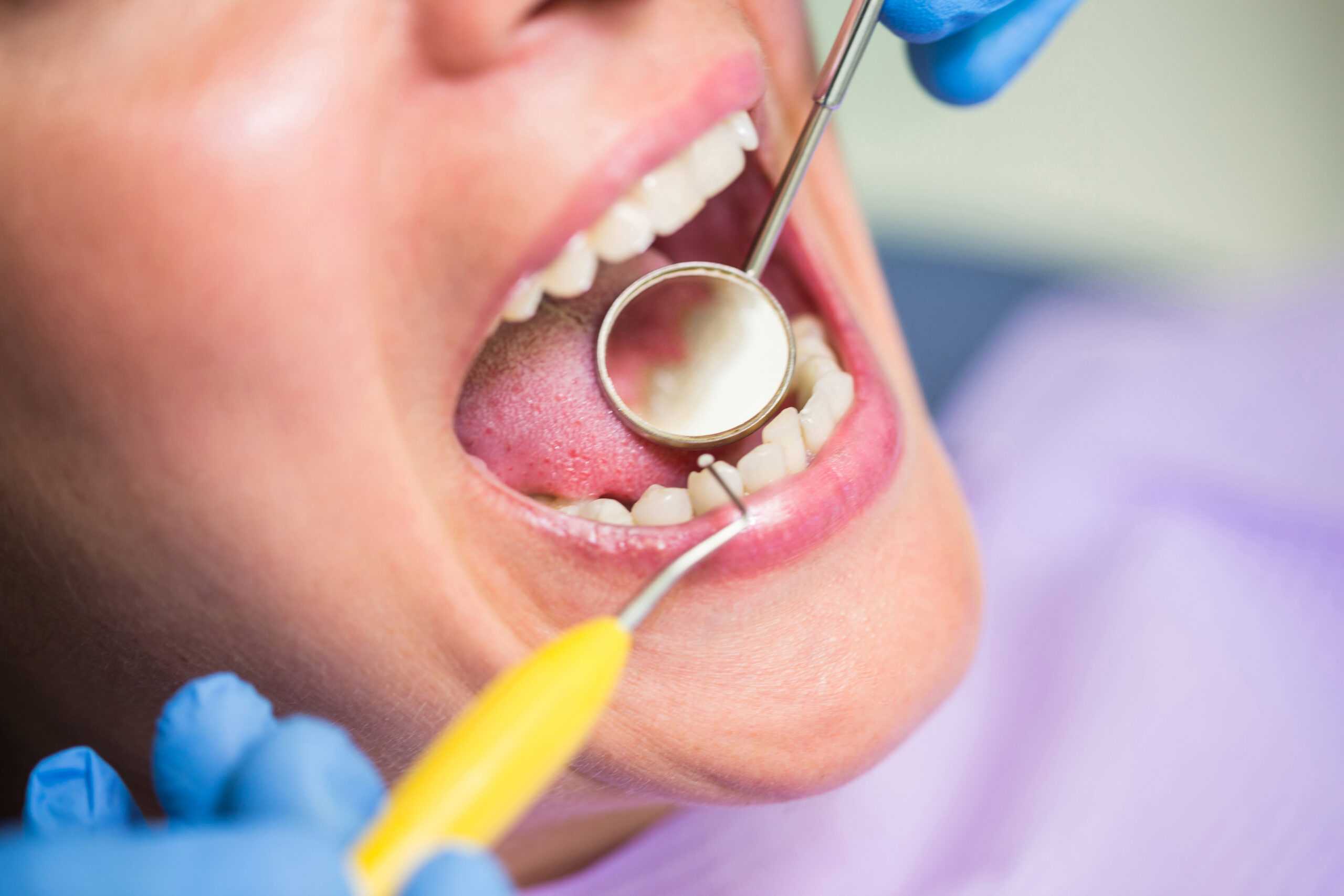 How to Remove Tartar from Teeth? – Credihealth Blog