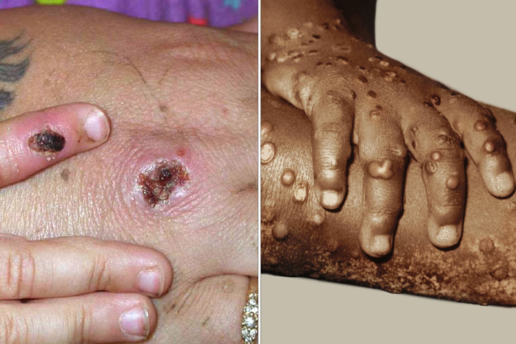 Ohio Reports Death of Monkeypox Patient