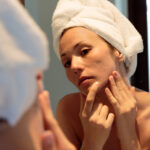 How to Treat Acne Naturally
