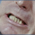 America’s Teeth Grinders Are Turning to Botox America’s Teeth Grinders Are Turning to Botox